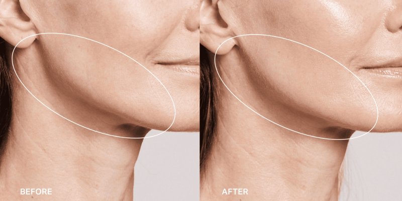 vorher_nachher_hydrafillic